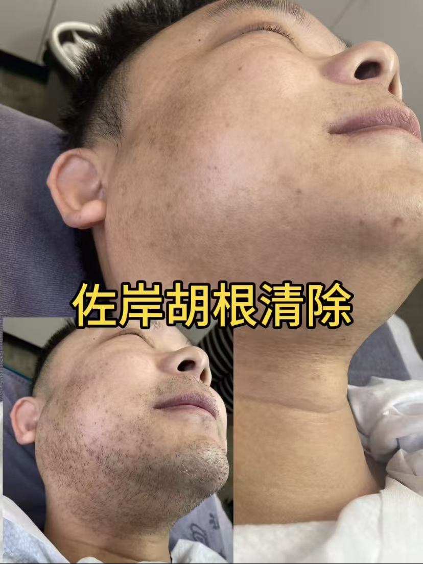金华脱毛